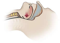 Sleep Apnea Diagram